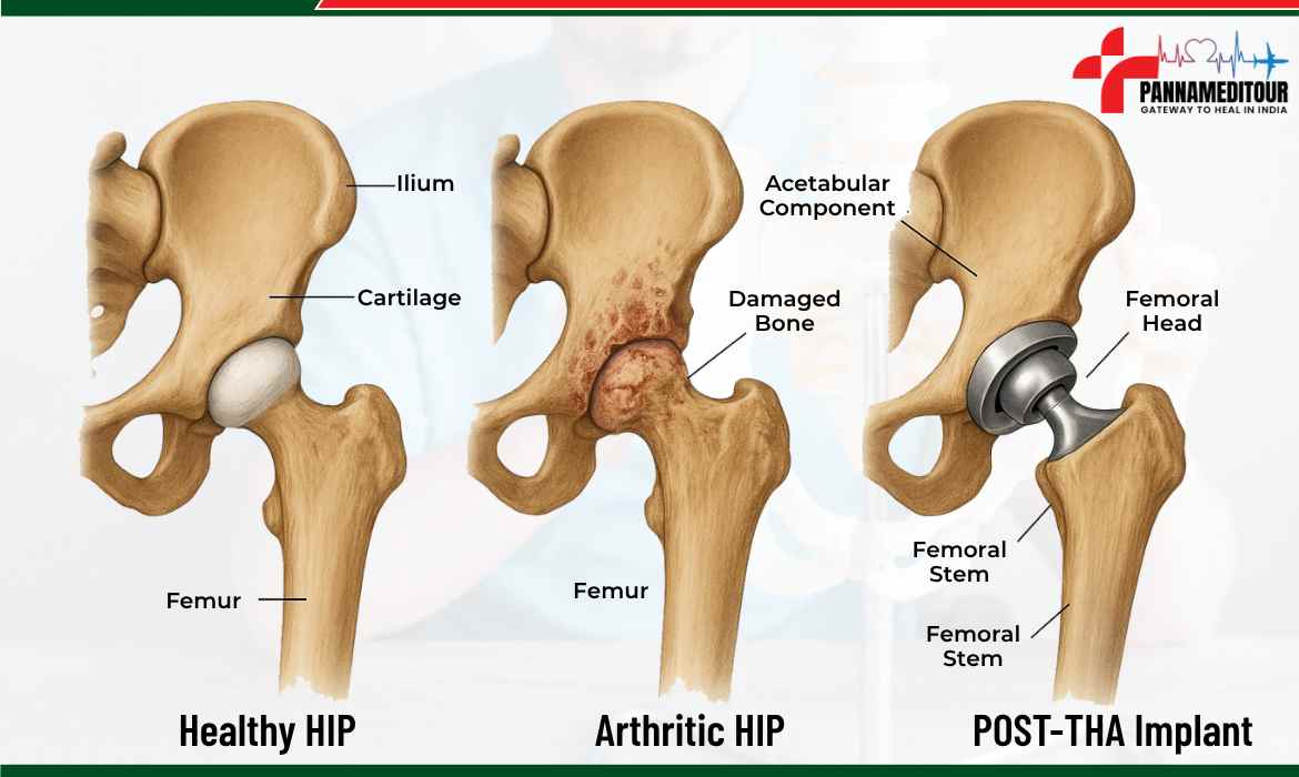 Hip Arthroplasty Vs Hip Replacement Guide To Procedure Risks Recovery Hip Arthroplasty Vs Hip Replacement Guide To Procedure Risks Recovery